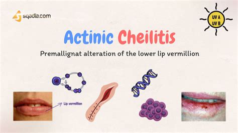 Actinic Cheilitis - Introduction