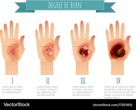 Degree of skin burns flat for Royalty Free Vector Image
