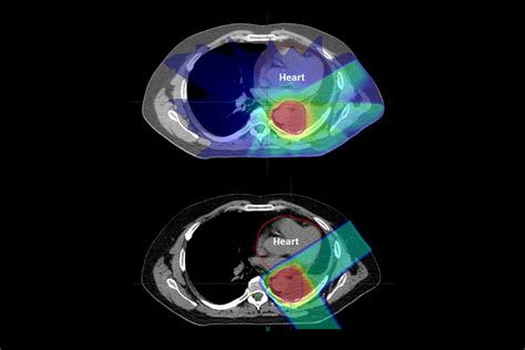 Proton therapy as effective as standard radiation with fewer side ...