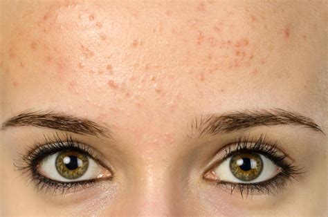 Forehead acne and pimples: Causes, treatment, and prevention