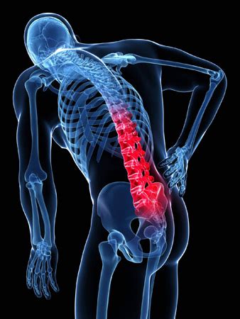 Antalgia - Acute Disc Injury | Mind & Body Chiropractic