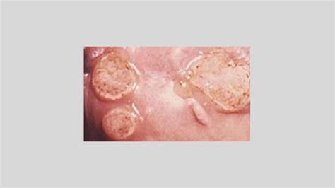 Granuloma Inguinale and Its Treatments