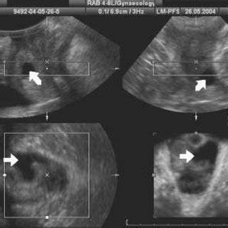 13. The complex appearance of a Gartner cyst on 3D ultrasound,... | Download Scientific Diagram