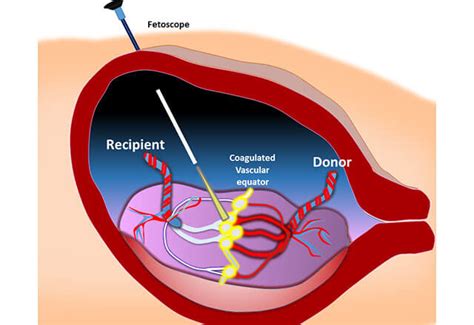 Fetoscopic Laser Surgery | Johns Hopkins Center for Fetal Therapy in Baltimore, Md.