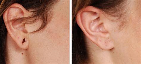 Ear Lobe Repair, Procedure and Cause and Treatment | Sab Clinic