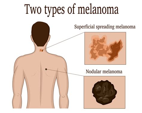 What Is Nodular Melanoma? - University Health News