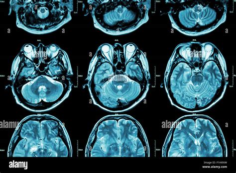 MRI of Brain ( cross section of brain ) ( Medical , Health care ...