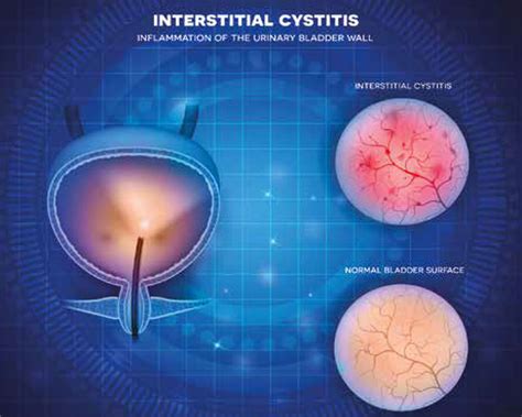 Interstitial cystitis: Algorithm to simplify diagnosis of chronic urinary symptoms