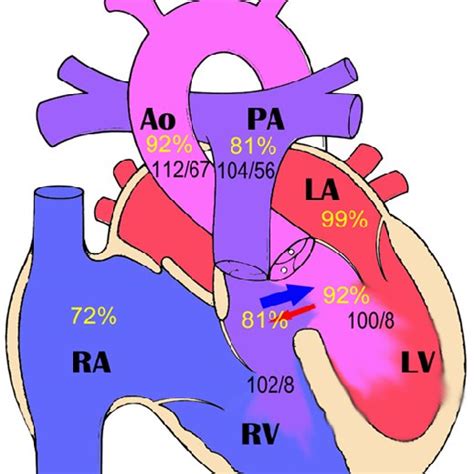 Right to left cardiac shunt symptoms