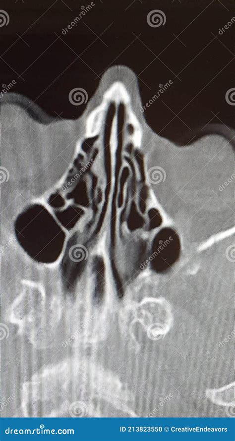 CT Scan of the Ethmoid Sinus Air Cells Stock Photo - Image of pneumatized, pneumatization: 213823550