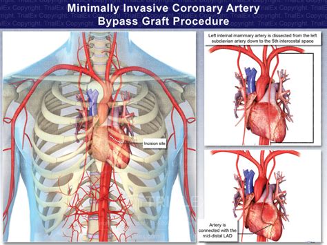 Coronary Artery Bypass Graft