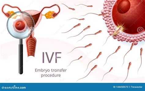 In Vitro Fertilization. Embryo Transfer Procedure Stock Vector - Illustration of laboratory ...