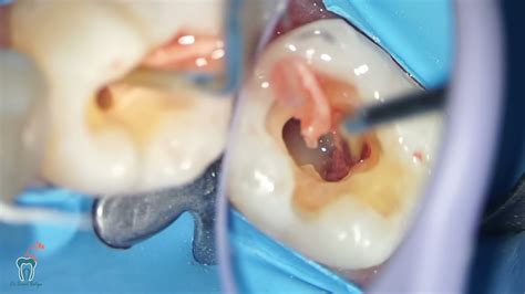 inside a tooth ischemic nerve - YouTube