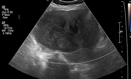 Ovarian Fibroma Ultrasound