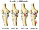 MCL Sprain: Causes, Symptoms, and Recovery - Phonemantra