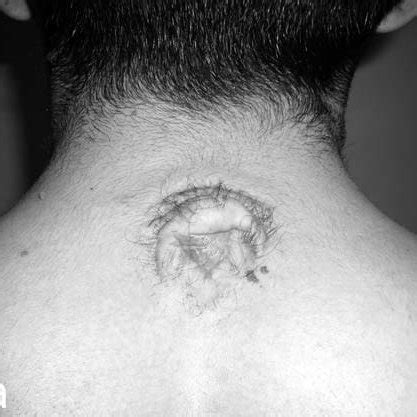 A: Photograph showing the meningocele located in the lower cervical region. | Download ...