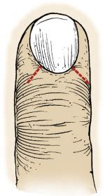 Perionychium | Musculoskeletal Key