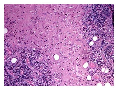 Scattered eosinophils are seen throughout (H&E staining, 100x). | Download Scientific Diagram