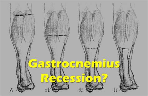 Should You Get Gastrocnemius Recession Surgery? - Regenexx