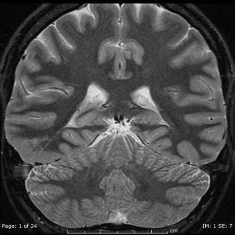 Focal cortical dysplasia - type I | Radiology Case | Radiopaedia.org | Radiology, Type i, Focal