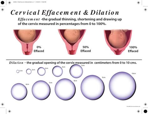 3 4 Cm Dilated | CSAMedicalCentre.com | Cervical effacement, Cervical ...