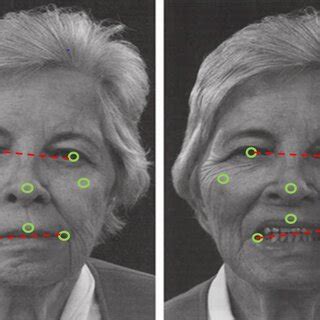 (PDF) The use of wearables for the diagnosis and treatment of Parkinson’s disease