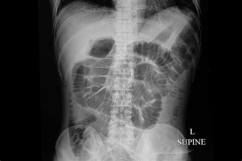 What are the Risk Factors and Symptoms of Epiploic Appendagitis ...