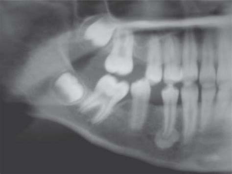 Oral Cavity: The Jaw and Teeth | Radiology Key