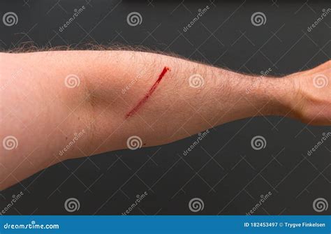 Bloody scar on a hairy arm stock image. Image of courage - 182453497