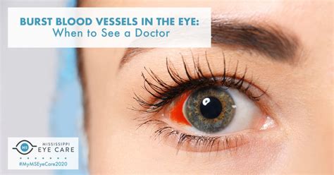 Burst Blood Vessels in the Eye: When to See a Doctor - Mississippi Eye Care