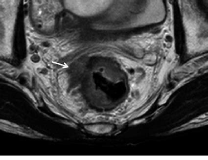 Magnetic resonance imaging (MRI) of rectal cancer. Arrow indicates ...