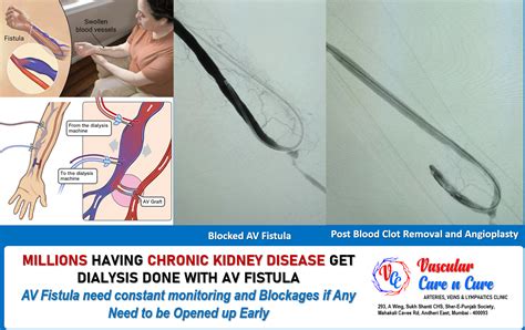 Arteriovenous Fistula – Facts – Vascular Care n Cure Clinic – Dr. Aniruddha Bhuiyan