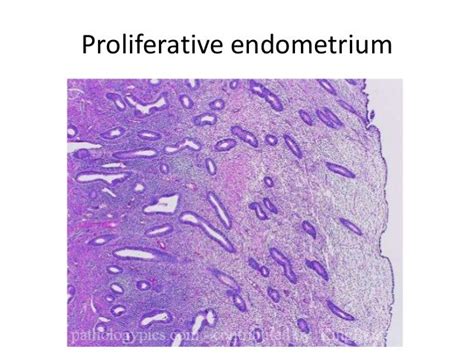 What is the treatment for disordered proliferative endometrium ...