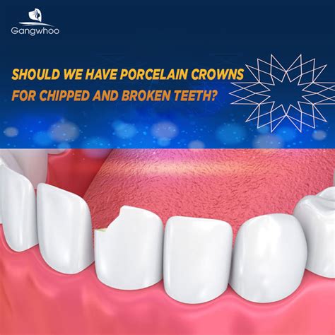 Porcelain Crown – For A Smile You've Ever Wanted - Gangwhoo Cosmetic ...