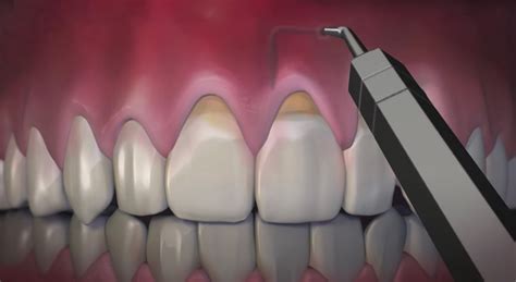 Pinhole Surgical Technique PST™ | Arkansas Periodontal and Implant Associates