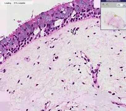 Histopathology Nose --Nasal polyp - YouTube