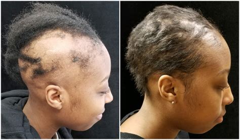 Details 153+ black hairstyles for alopecia super hot - ceg.edu.vn