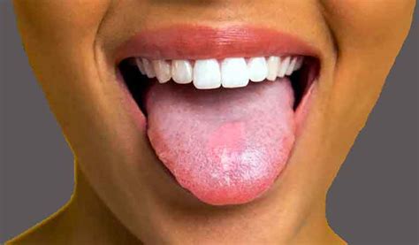 Tongue Diseases Pictures - img-i