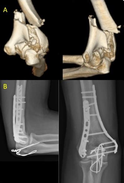 Distal Humerus Anatomy