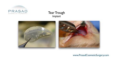 Tear Trough Implants for Hollow Under Eyes | New York