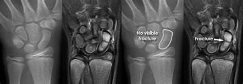 Scaphoid Fracture Mri