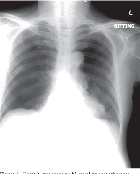 Figure 1 from A Fatal Case of Iatrogenic Bilateral Pneumothorax after Acupuncture | Semantic Scholar