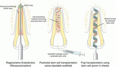 The Future: Stem Cells and Biological Approaches for Pulp Regeneration ...