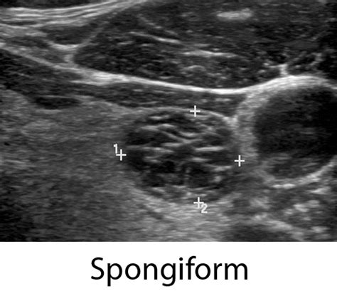 Spongiform Nodule Ultrasound