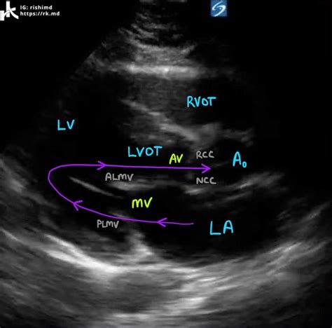 Cardiac Transthoracic Echocardiography (TTE) - Summary And Labeled Views | RK.MD