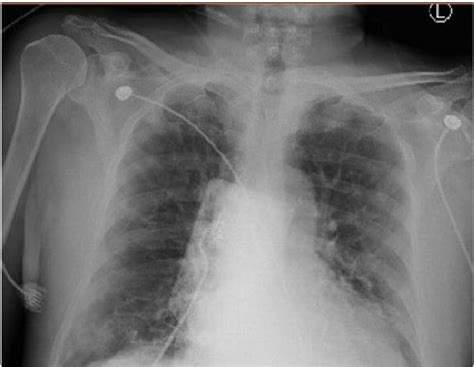 Chest x-ray showing bilateral peripheral patchy infiltrates consistent... | Download Scientific ...