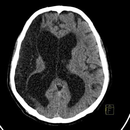 Basal Ganglia Encephalomalacia