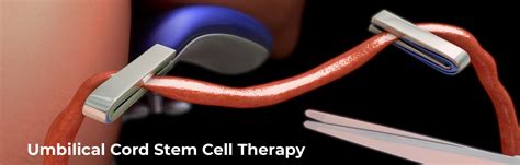 Umbilical Cord Tissue | Stem Cell Therapy Seattle and Bothell WA