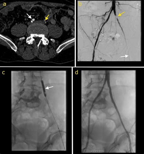 Iliac artery stenting - Radiology at St. Vincent's University Hospital