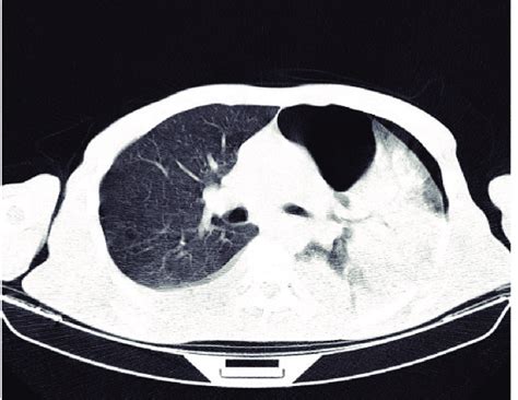 Chest CT scan of patient 2 showing a moderate left sided pneumothorax. | Download Scientific Diagram